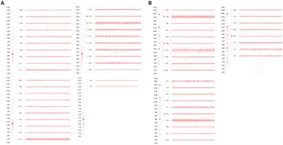 Bilateral globus pallidus interna deep brain stimulation in the treatment of mixed cerebral palsy in ataxia with dyskinesia: a case report